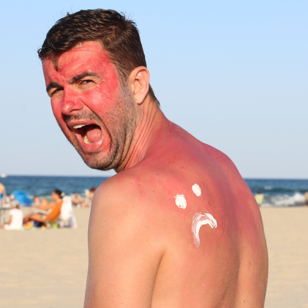 Sonnenbrand, Sommer, Sonne, Urlaub, Hausmittel, natürliche Hausmittel, Sonnenschutz, Kinder, Erwachsene